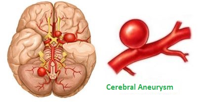 CEREBRAL ANEURYSM Overview And Treatments HKBSSP