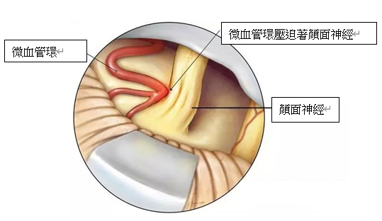 微血管環壓迫著顏面神經 微血管環壓迫著顏面神經