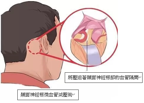 Hemifacial Spasm Hemifacial Spasm