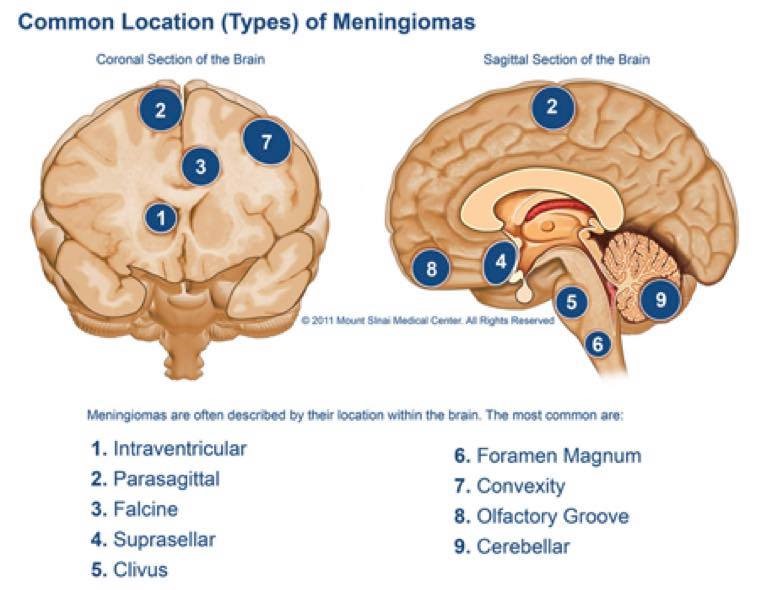 腦膜瘤的種類及位置
