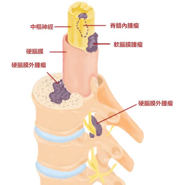 脊椎內腫瘤