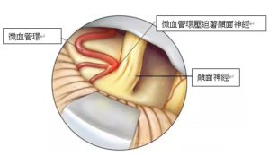 微血管環壓迫著顏面神經