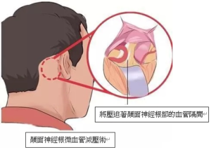 Hemifacial Spasm