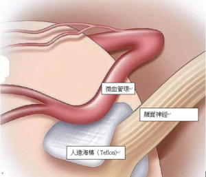 Hemifacial Spasm Surgeon