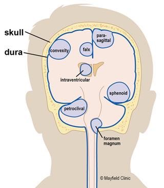 腦膜瘤的位置