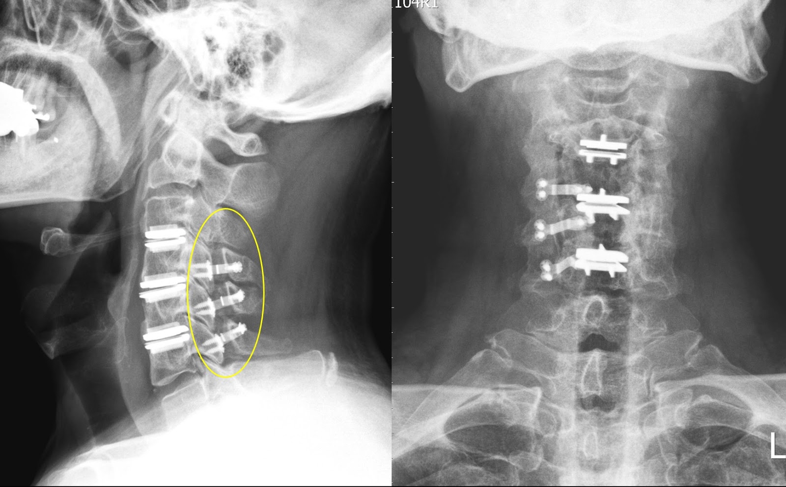 Cervical Spine Surgery