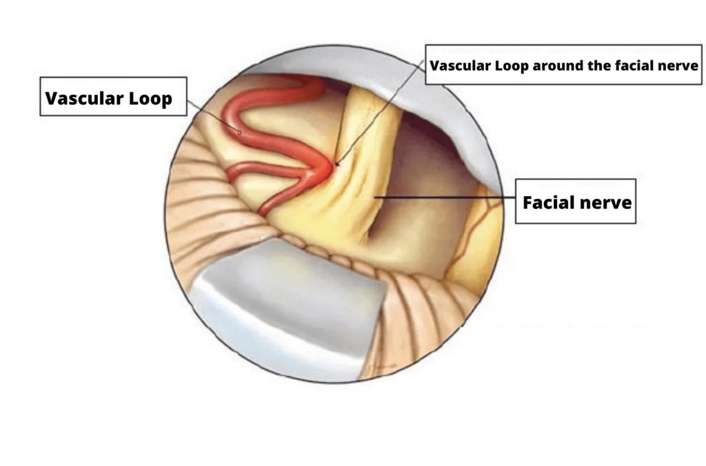 Hemifacial Spasm - Unusual Eye Twitching
