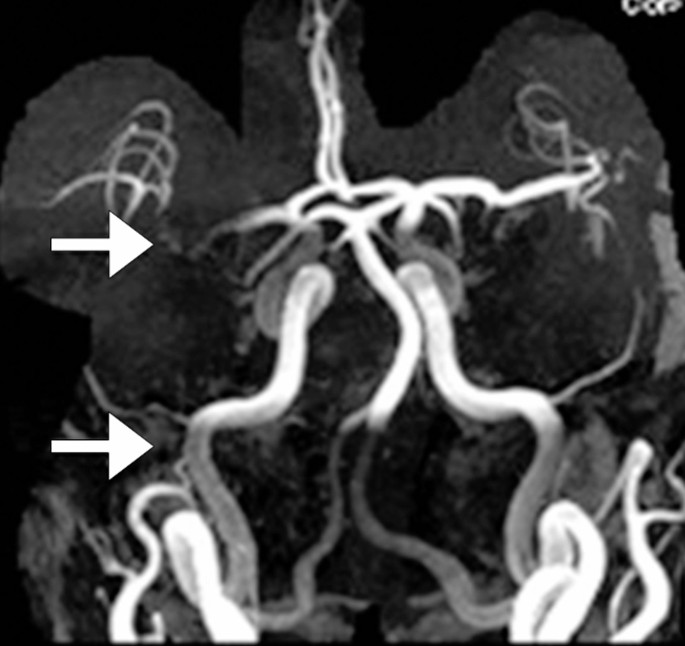 3D腦血管造影 ( MR Angiogram of Brain) 可偵測導致急性缺血性中風的腦血管狹窄