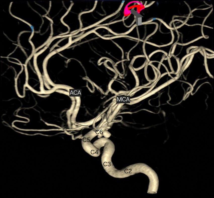 3D腦血管造影 ( MR Angiogram of Brain) 可偵測導致急性缺血性中風的腦血管狹窄