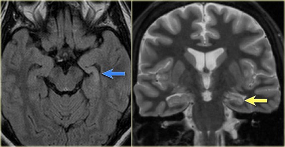 MRI 磁力共振顯示左側顳葉內側硬化症是引致癲癇的位置