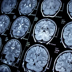 MRI Scan - Brain