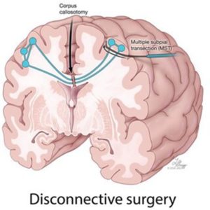 Disconnective-surgery