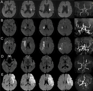 MRI 在黃金小時偵測大腦多個部位的急性缺血性中風