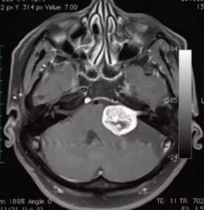 腫瘤對小腦、腦幹的壓力。