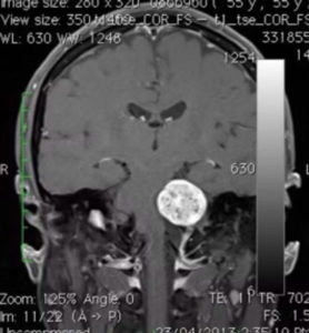可見聽覺神經瘤由內聽道向內側長出來，像蝌蚪的尾巴一樣。