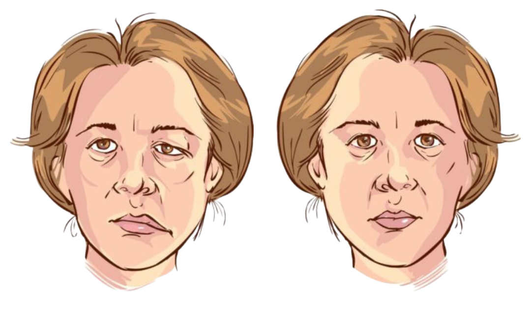 facial-palsy-2