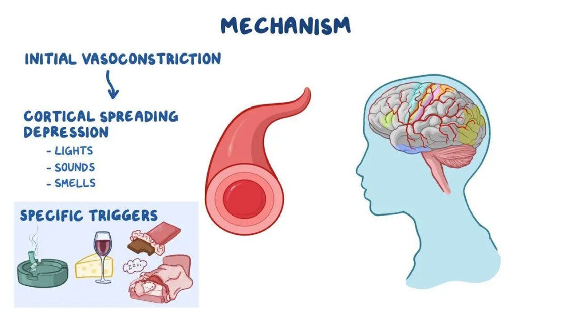 migraine6