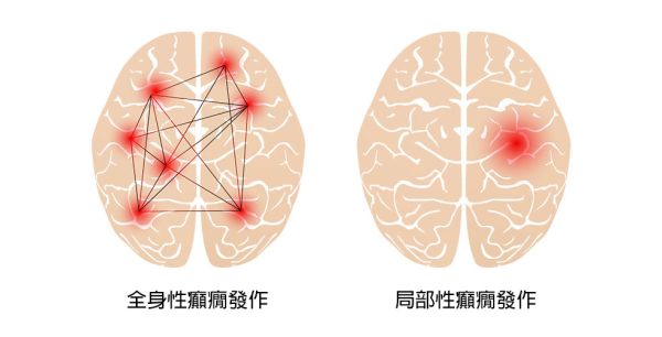 Different-kinds-of-seizures-chinese