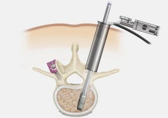 Minimally-Invasive-Spine-Surgery-1 Minimally-Invasive Spine-Surgery-Eng.jpg