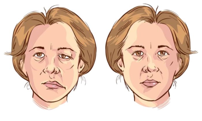 facial-palsy-2